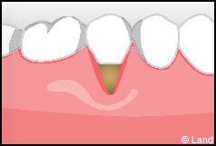 Chirurgie mucogingivale