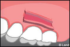 Chirurgie mucogingivale